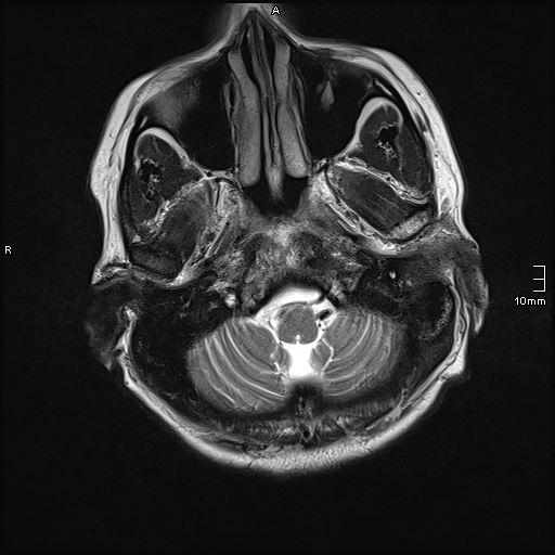 File:Neurotoxoplasmosis - concentric target sign (Radiopaedia 70644-80784 Axial T2 3).jpg