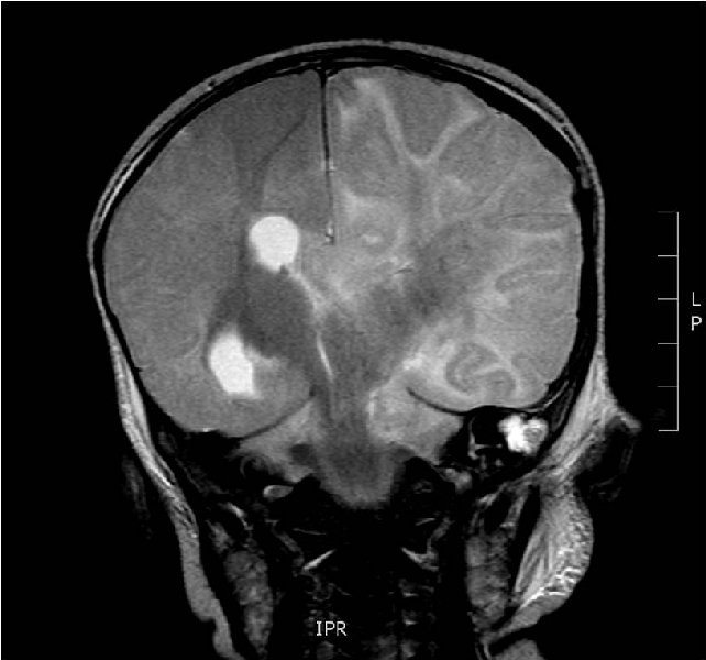 File:Non-accidental injury - intracranial injuries and skull fracture (Radiopaedia 17753-17509 Coronal T2 1).jpg