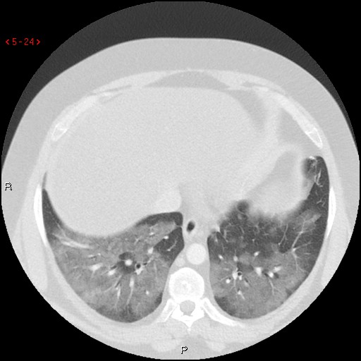 File:Non-specific interstitial pneumonitis (Radiopaedia 27044-27222 Axial lung window 15).jpg