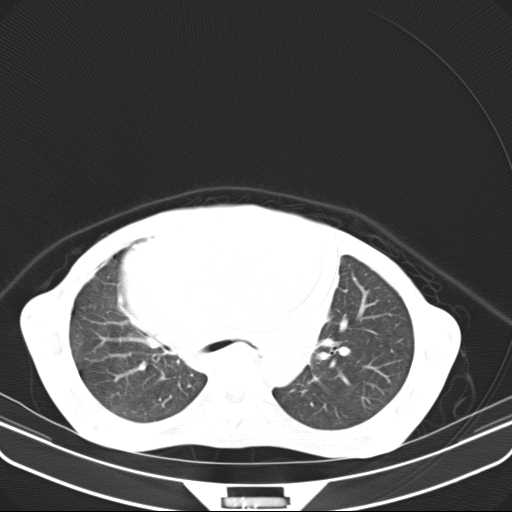 File:Non hodgkin lymphoma of the mediastinum (Radiopaedia 20814-20729 Axial lung window 20).jpg