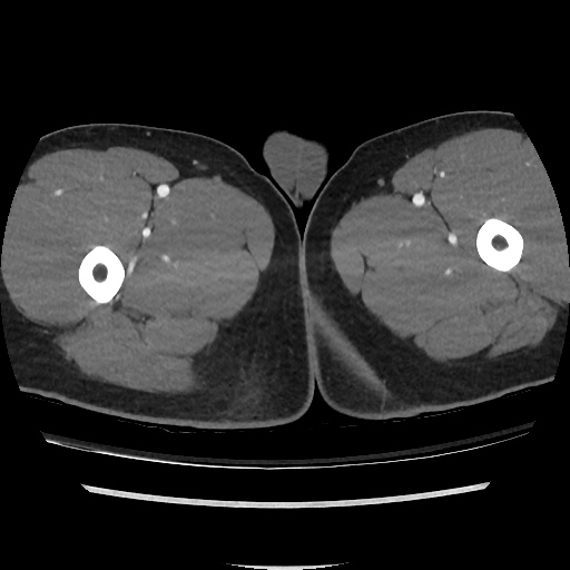 File:Normal CT angiogram of pelvis (Radiopaedia 45390-49430 A 71).jpg