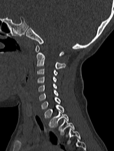 File:Normal CT cervical spine - pediatric (Radiopaedia 52549-58462 Sagittal bone window 135).jpg