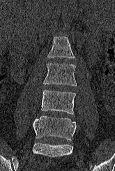 Normal CT lumbar spine (Radiopaedia 53981-60118 Coronal bone window 20).jpg
