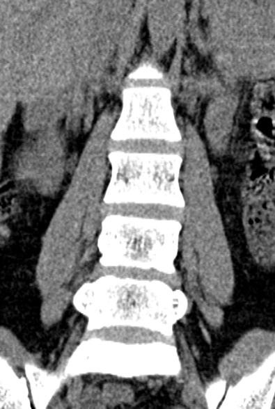Normal CT lumbar spine (Radiopaedia 53981-60118 F 30).jpg