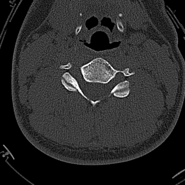 Normal CT of the cervical spine (Radiopaedia 53322-59305 Axial bone window 139).jpg