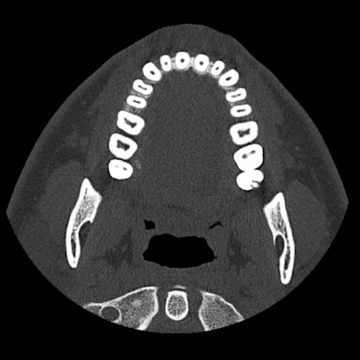 Normal CT paranasal sinuses (Radiopaedia 42286-45390 Axial bone window 109).jpg