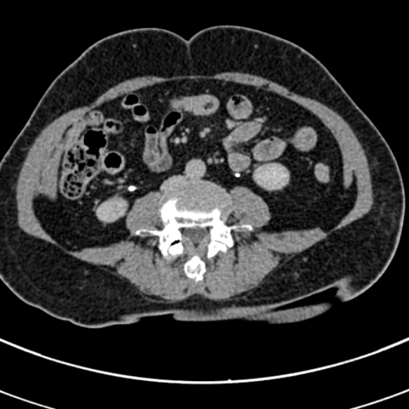 File:Normal CT split bolus study of the renal tract (Radiopaedia 48631-53634 Axial split bolus 154).jpg