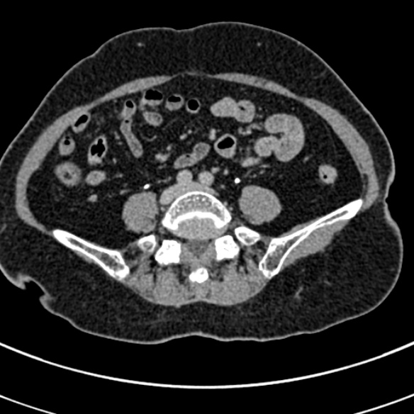 File:Normal CT split bolus study of the renal tract (Radiopaedia 48631-53634 Axial split bolus 179).jpg