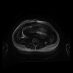 Normal MRI abdomen in pregnancy (Radiopaedia 88001-104541 Axial DWI 106).jpg