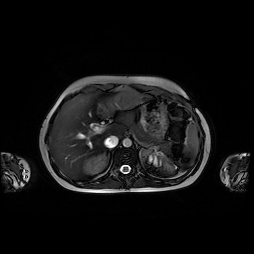 File:Normal MRI abdomen in pregnancy (Radiopaedia 88001-104541 Axial Gradient Echo 12).jpg