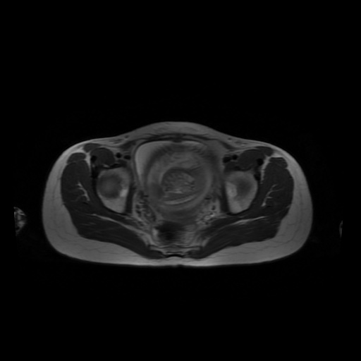File:Normal MRI abdomen in pregnancy (Radiopaedia 88001-104541 Axial T2 63).jpg