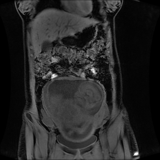Normal MRI abdomen in pregnancy (Radiopaedia 88001-104541 M 48).jpg