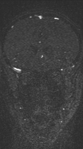 Normal MRI brain with MRV- teenager (Radiopaedia 49425-54553 Coronal MRV 90).jpg