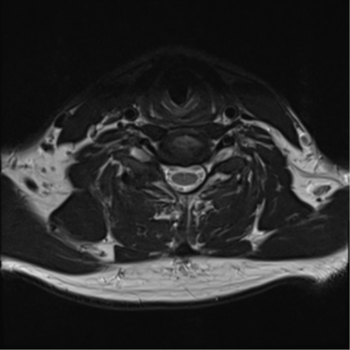 File:Normal MRI cervical spine (infection protocol) (Radiopaedia 53916-60039 Axial T2 35).png