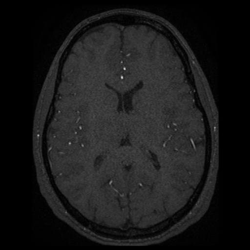Normal brain MRA (Radiopaedia 41046-43793 Axial MRA 9).png