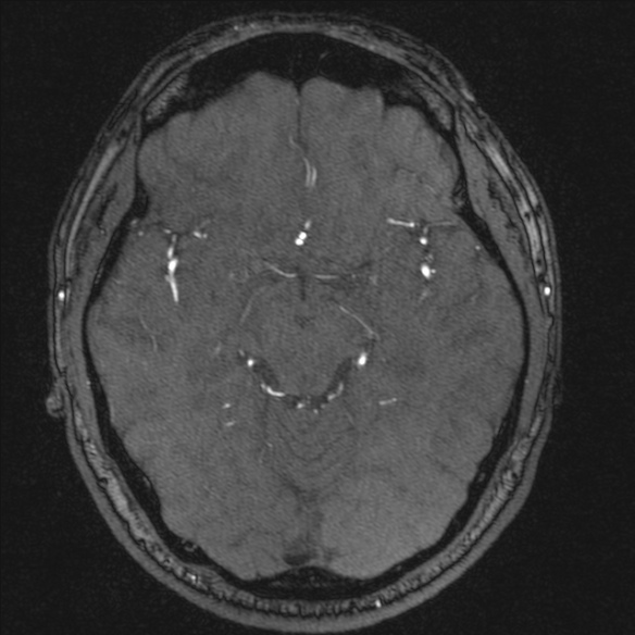 Normal brain MRI including MRA (Radiopaedia 48748-53763 Axial MRA 91).jpg