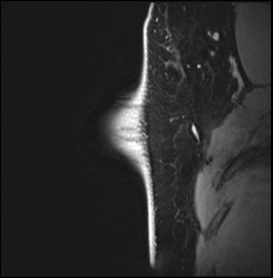 Normal breast MRI - dense breasts (Radiopaedia 80454-93850 I 40).jpg