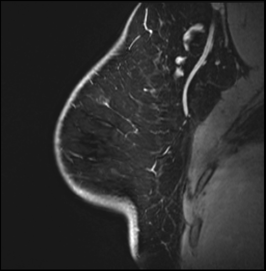 Normal breast MRI - dense breasts (Radiopaedia 80454-93850 I 51).jpg