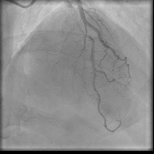 Normal coronary angiogram (DSA) (Radiopaedia 63081-71571 E 74).jpg