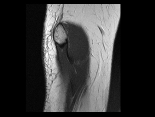 File:Normal elbow arthrograms (Radiopaedia 75550-86805 Sagittal PD 34).jpg