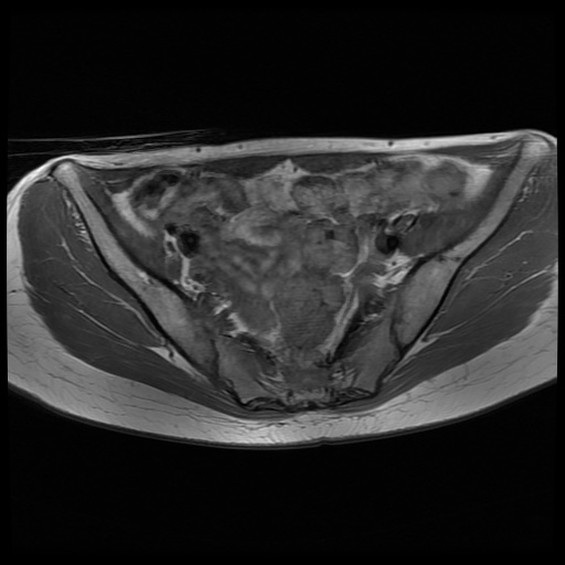 File:Normal female pelvis MRI (retroverted uterus) (Radiopaedia 61832-69933 Axial T1 13).jpg