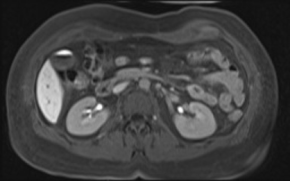 File:Normal hepatobiliary phase liver MRI (Radiopaedia 58968-66230 A 62).jpg