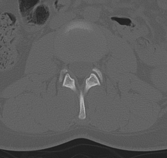 File:Normal lumbar spine CT (Radiopaedia 46533-50986 Axial bone window 30).png