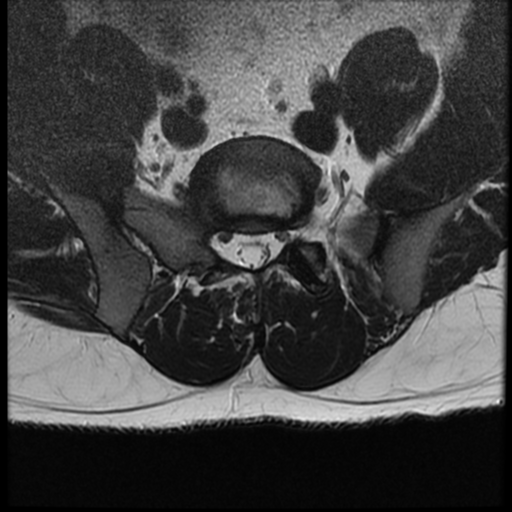 File:Normal lumbar spine MRI (Radiopaedia 35543-37039 Axial T2 6).png