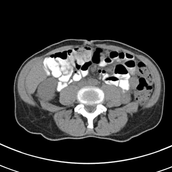 File:Normal multiphase CT liver (Radiopaedia 38026-39996 Axial non-contrast 50).jpg
