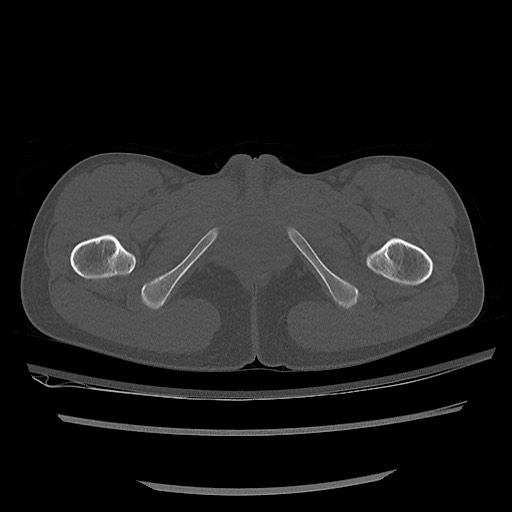 Normal pelvis CT (Radiopaedia 51471-57236 Axial bone window 98).jpg