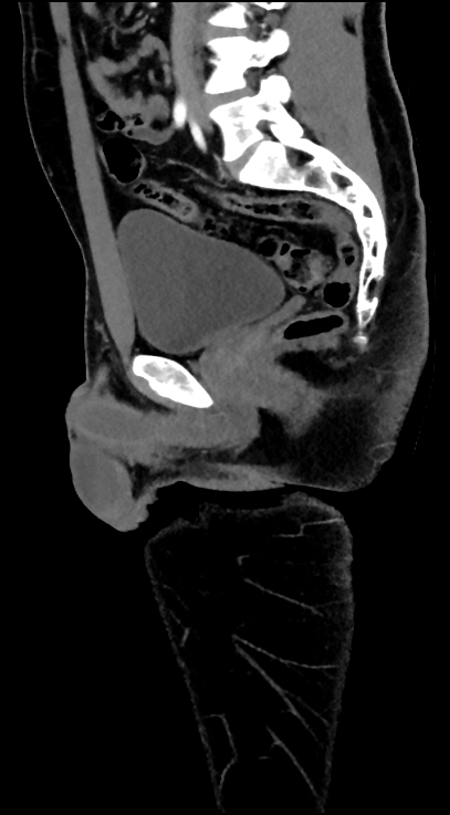 Normal pelvis CT angiogram (Radiopaedia 84966-100481 C 51).jpg