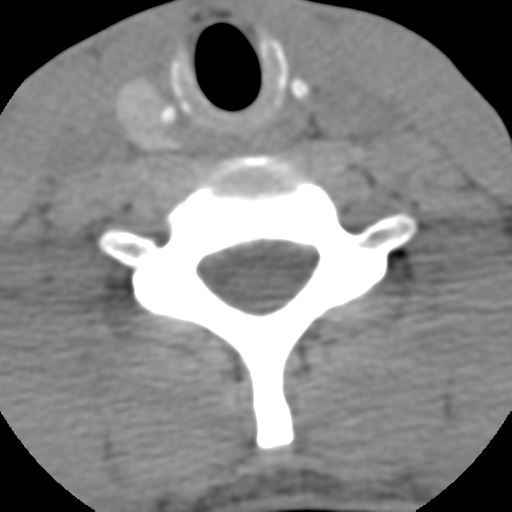 Normal trauma cervical spine (Radiopaedia 41017-43760 Axial non-contrast 45).png