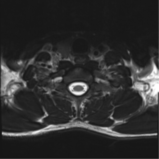 Normal trauma cervical spine (Radiopaedia 41017-43762 D 50).png
