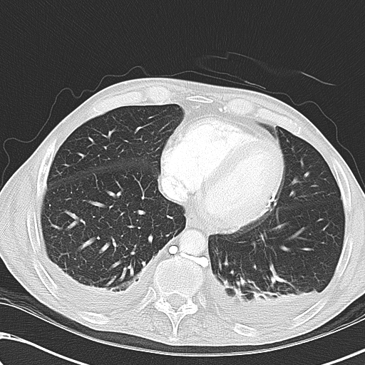 File:Obstructive superior vena cava tumor thrombus (Radiopaedia 28046-28306 Axial lung window 40).jpg