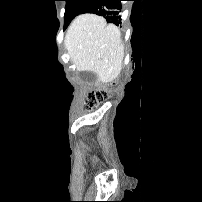 Obturator hernia causing small bowel obstruction (Radiopaedia 65522-74612 C 87).jpg