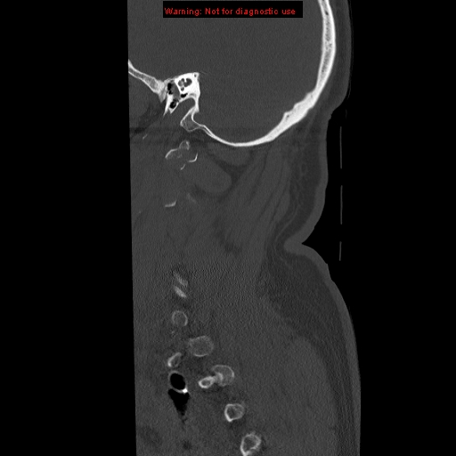 File:Occipital condyle fracture (Radiopaedia 18366-18208 Sagittal bone window 2).jpg