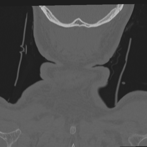 File:Occipital condyle fracture (Radiopaedia 33467-34517 Coronal bone window 74).png