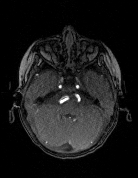 Occipital horn syndrome (Radiopaedia 14255-14129 MRA 40).jpg