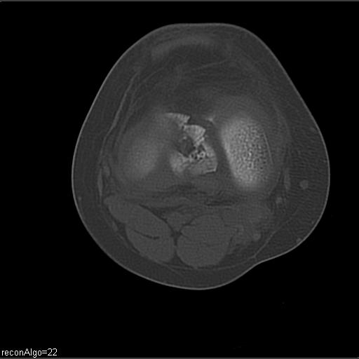 File:ACL avulsion fracture (Radiopaedia 33833-34994 Axial bone window 17).jpg