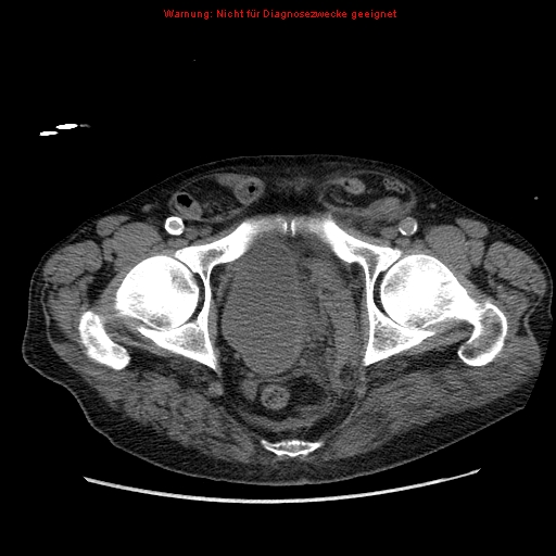 Abdominal aortic aneurysm- extremely large, ruptured (Radiopaedia 19882-19921 Axial C+ arterial phase 75).jpg