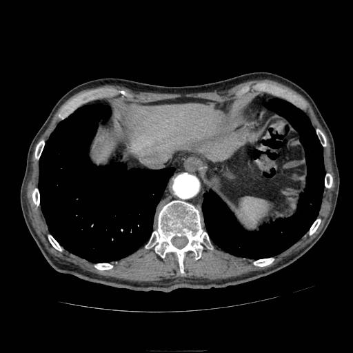 Abdominal aortic aneurysm (Radiopaedia 13341-13340 Axial C+ arterial phase 16).jpg