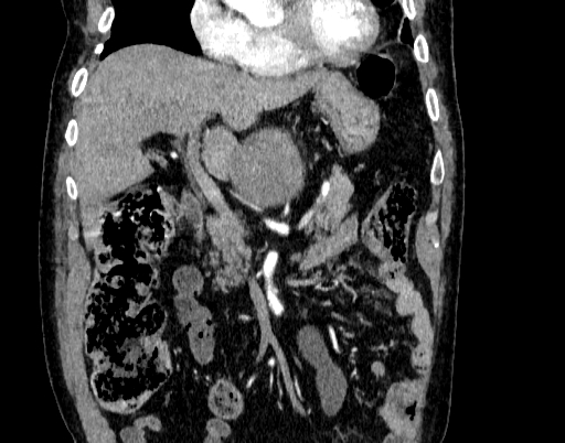 Abdominal aortic aneurysm (Radiopaedia 67117-76452 Coronal C+ arterial phase 23).jpg
