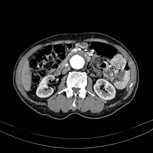 File:Abdominal aortic aneurysm (Radiopaedia 83581-98689 Axial C+ arterial phase 56).jpg