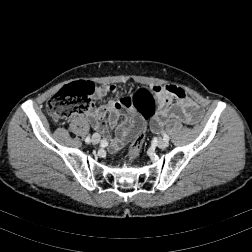 Abdominal aortic aneurysm (Radiopaedia 83581-98689 Axial C+ portal venous phase 88).jpg