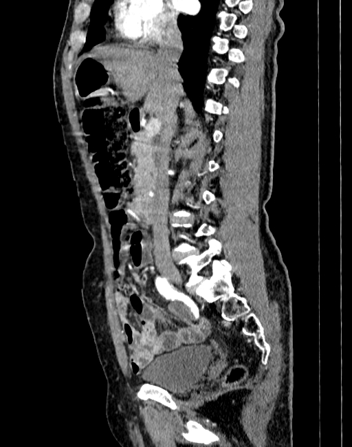 Abdominal aortic aneurysm (Radiopaedia 83581-98689 Sagittal C+ arterial phase 26).jpg