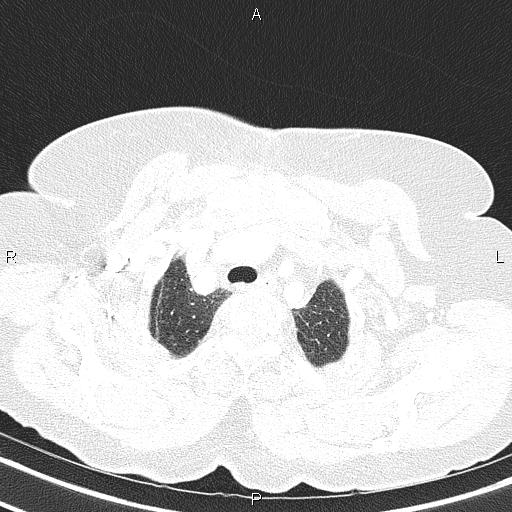 File:Abdominal aortic aneurysm (Radiopaedia 85063-100606 Axial lung window 14).jpg