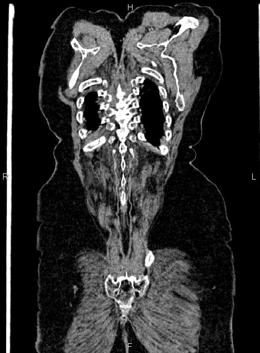 Abdominal aortic aneurysm (Radiopaedia 85063-100606 Coronal C+ arterial phase 58).jpg