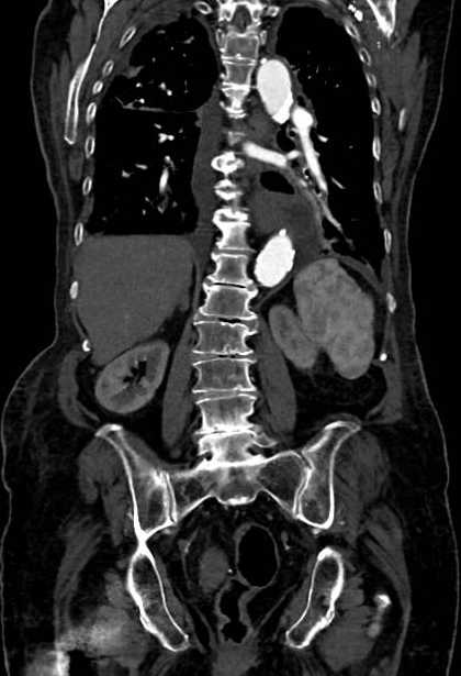 Abdominal aortic aneurysm with thrombus fissuration (Radiopaedia 73192-83919 Coronal C+ arterial phase 60).jpg