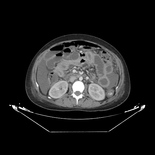 Abdominal gossypiboma- surgical towel (Radiopaedia 57288-64226 Axial C+ portal venous phase 28).jpg
