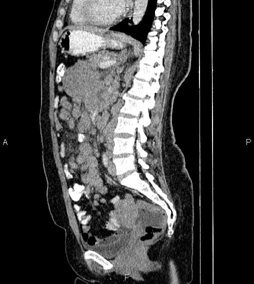 Abdominal lymphoma with sandwich sign (Radiopaedia 84378-99704 Sagittal C+ portal venous phase 52).jpg